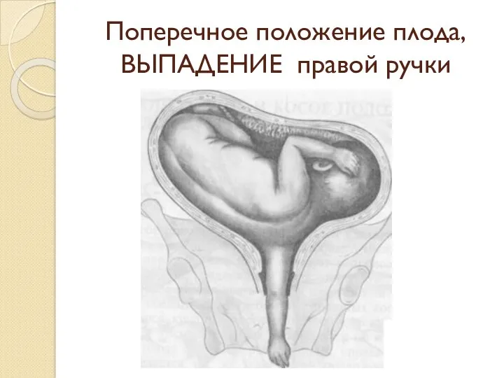 Поперечное положение плода, ВЫПАДЕНИЕ правой ручки