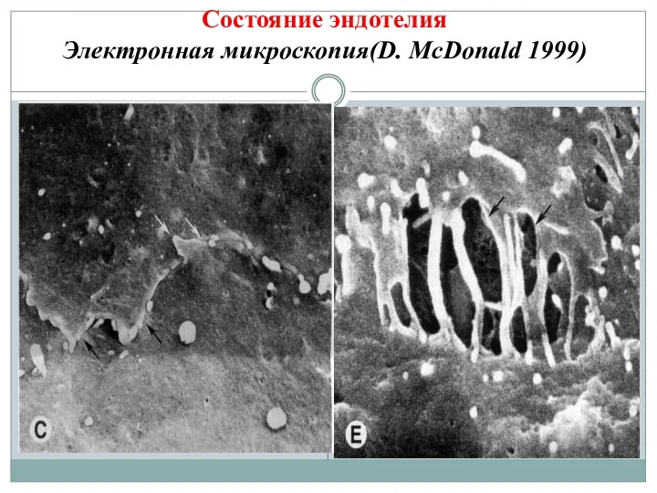 Состояние эндотелия Электронная микроскопия(D. McDonald 1999)