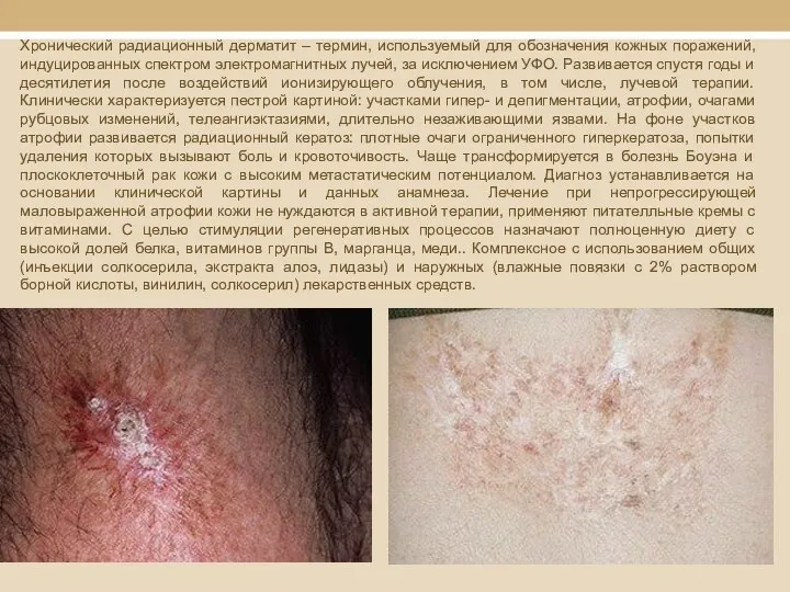 Хронический радиационный дерматит – термин, используемый для обозначения кожных поражений,