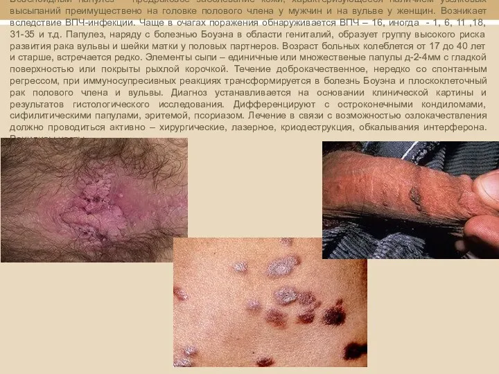 Бовеноидный папулез – предраковое заболевание кожи, характеризующееся наличием узелковых высыпаний