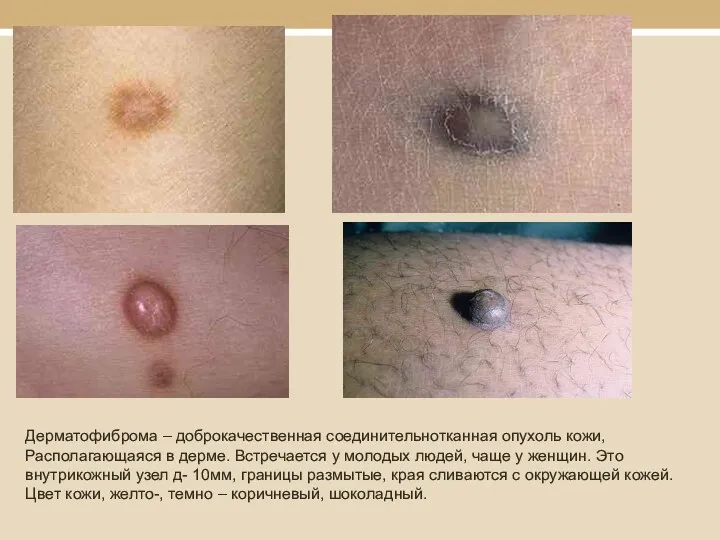 Дерматофиброма – доброкачественная соединительнотканная опухоль кожи, Располагающаяся в дерме. Встречается
