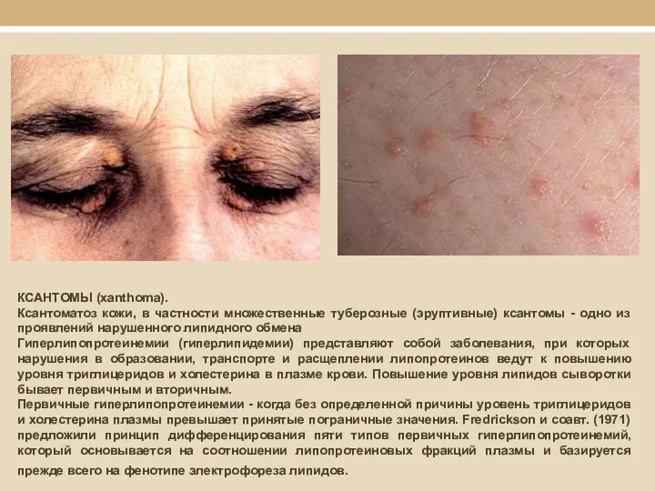 КСАНТОМЫ (xanthoma). Ксантоматоз кожи, в частности множественные туберозные (эруптивные) ксантомы