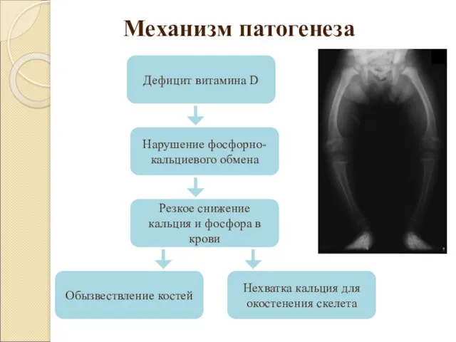 Механизм патогенеза Дефицит витамина D Нарушение фосфорно-кальциевого обмена Резкое снижение кальция и фосфора