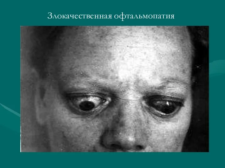 Злокачественная офтальмопатия