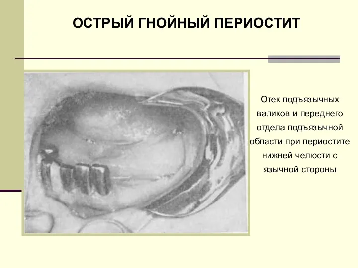 Отек подъязычных валиков и переднего отдела подъязычной области при периостите нижней челюсти с