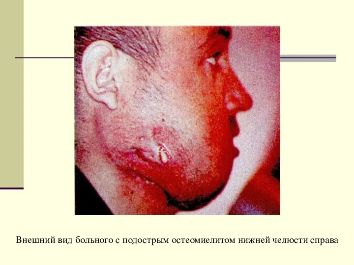 Внешний вид больного с подострым остеомиелитом нижней челюсти справа