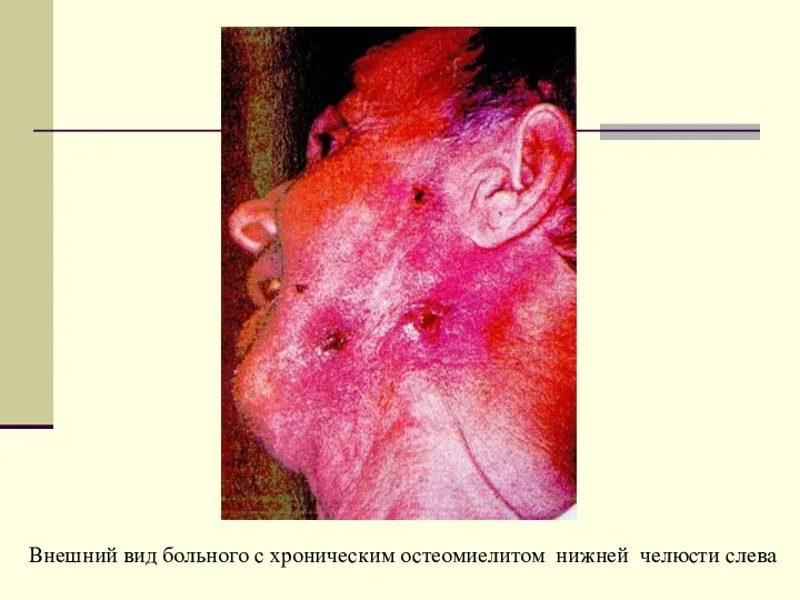 Внешний вид больного с хроническим остеомиелитом нижней челюсти слева