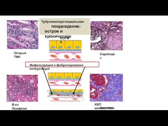В-кл Лимфома Острый ТИН Саркоидоз ХБП неизвестной этиологии Тубулоинтерстициальное повреждение: