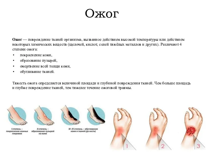 Ожог Ожог — повреждение тканей организма, вызванное действием высокой температуры