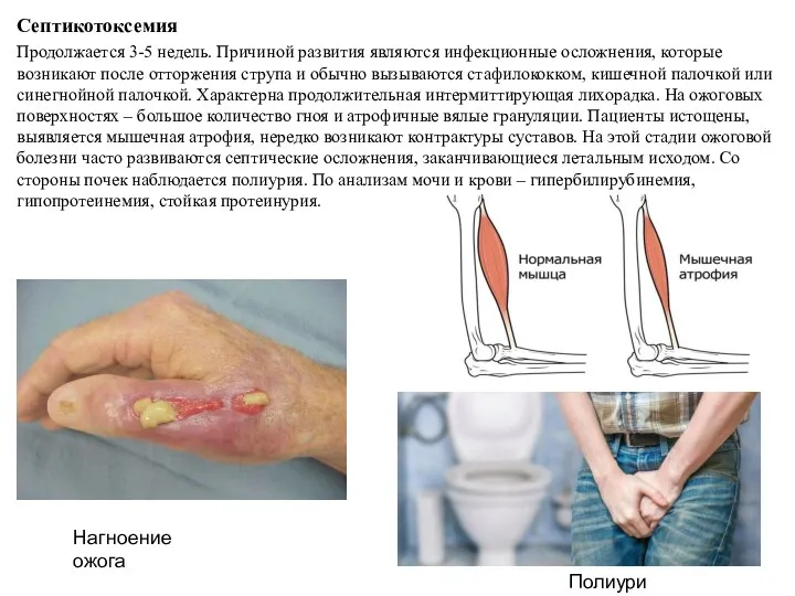 Септикотоксемия Продолжается 3-5 недель. Причиной развития являются инфекционные осложнения, которые