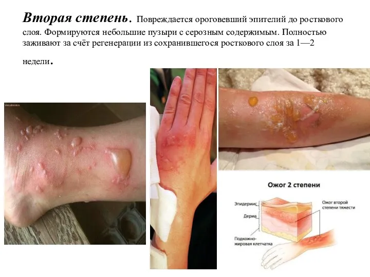 Вторая степень. Повреждается ороговевший эпителий до росткового слоя. Формируются небольшие