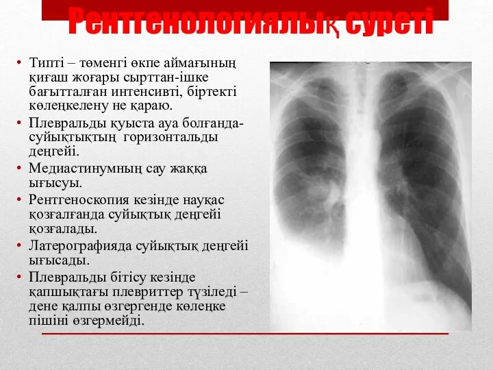 Рентгенологиялық суреті Типті – төменгі өкпе аймағының қиғаш жоғары сырттан-ішке