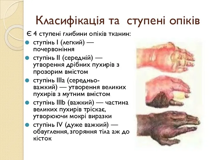 Класифікація та ступені опіків Є 4 ступені глибини опіків тканин: