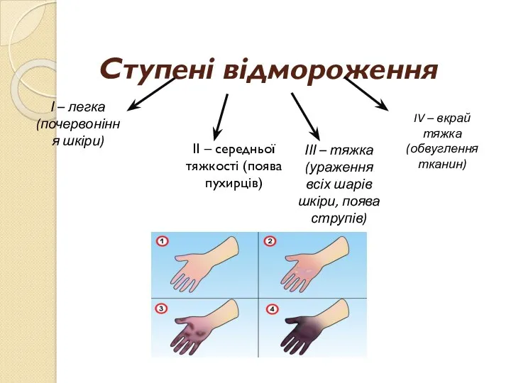 Ступені відмороження ІІ – середньої тяжкості (поява пухирців) І –