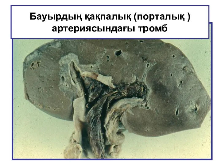 Бауырдың қақпалық (порталық ) артериясындағы тромб