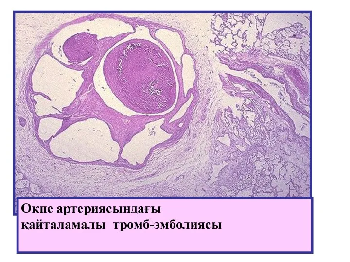 Өкпе артериясындағы қайталамалы тромб-эмболиясы