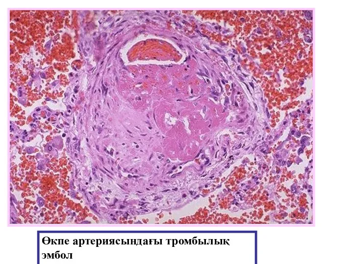 Өкпе артериясындағы тромбылық эмбол