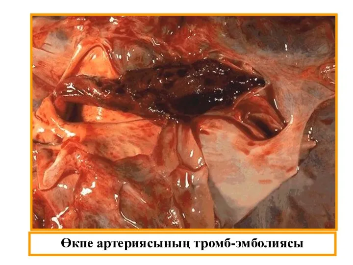 Өкпе артериясының тромб-эмболиясы