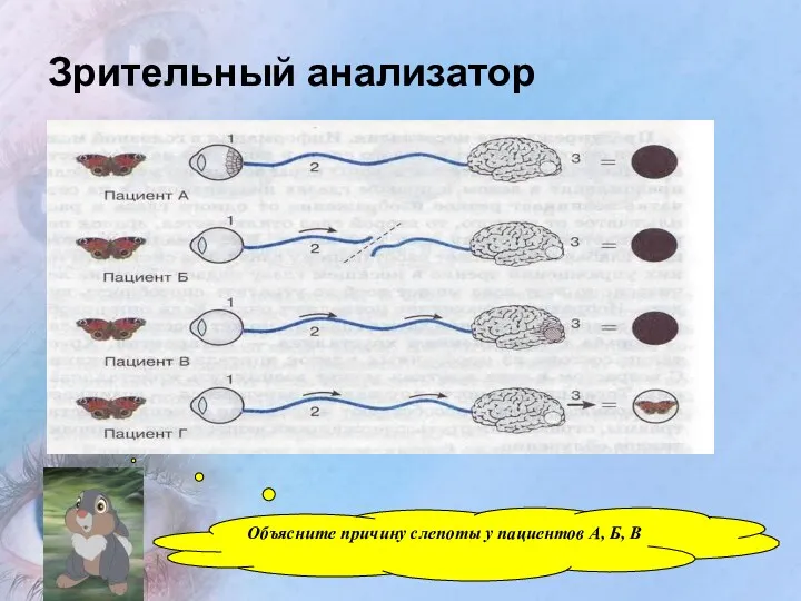 Зрительный анализатор Объясните причину слепоты у пациентов А, Б, В