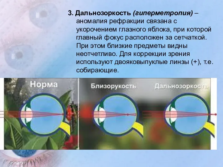 3. Дальнозоркость (гиперметропия) – аномалия рефракции связана с укорочением глазного