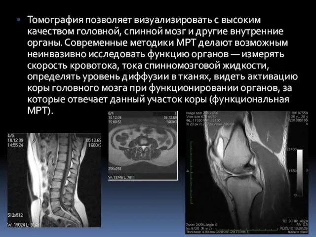 Томография позволяет визуализировать с высоким качеством головной, спинной мозг и другие внутренние органы.