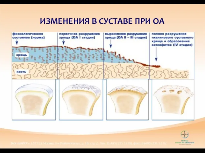 ИЗМЕНЕНИЯ В СУСТАВЕ ПРИ ОА