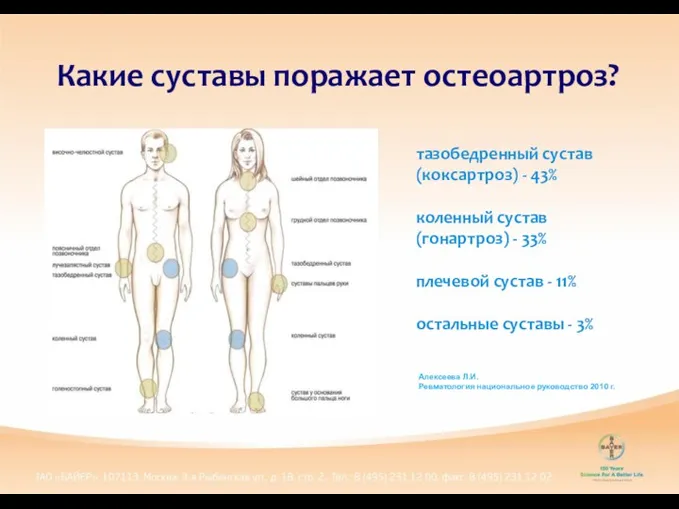 Какие суставы поражает остеоартроз? тазобедренный сустав (коксартроз) - 43% коленный