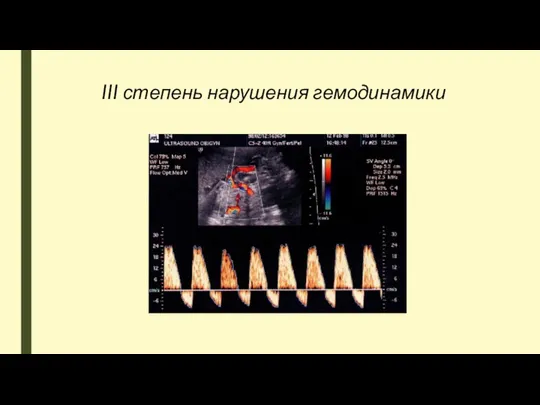 III степень нарушения гемодинамики