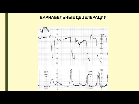 ВАРИАБЕЛЬНЫЕ ДЕЦЕЛЕРАЦИИ