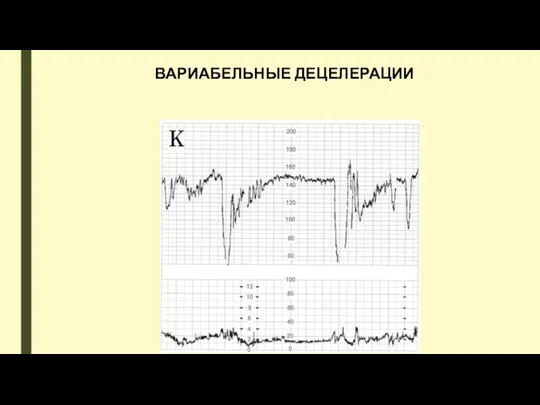 ВАРИАБЕЛЬНЫЕ ДЕЦЕЛЕРАЦИИ