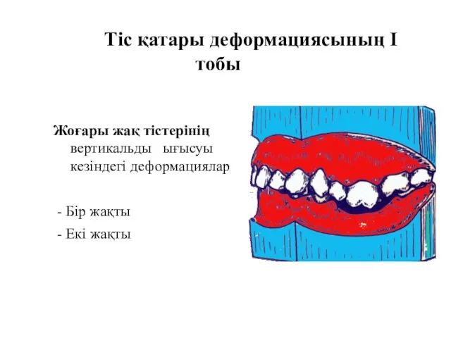 Тіс қатары деформациясының I тобы Жоғары жақ тістерінің вертикальды ығысуы