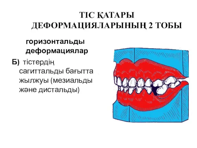 ТІС ҚАТАРЫ ДЕФОРМАЦИЯЛАРЫНЫҢ 2 ТОБЫ горизонтальды деформациялар Б) тістердің сагиттальды бағытта жылжуы (мезиальды және дистальды)