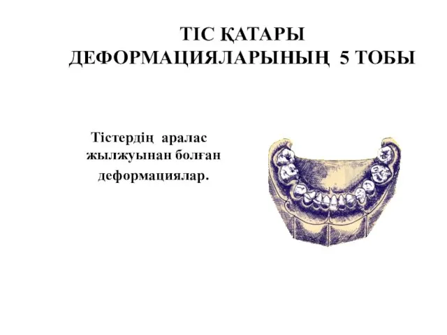 ТІС ҚАТАРЫ ДЕФОРМАЦИЯЛАРЫНЫҢ 5 ТОБЫ Тістердің аралас жылжуынан болған деформациялар.