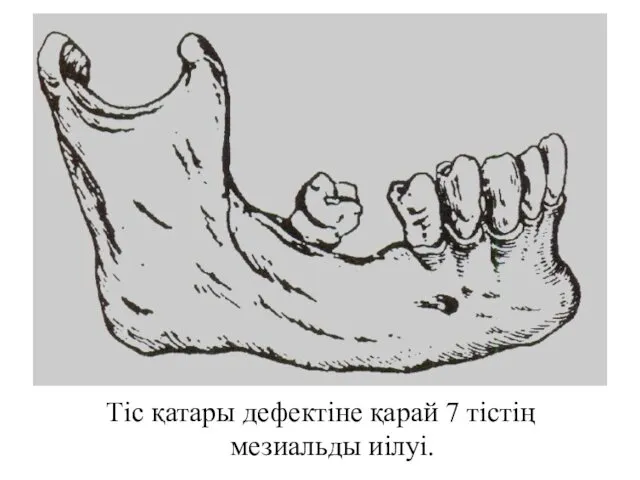 Тіс қатары дефектіне қарай 7 тістің мезиальды иілуі.