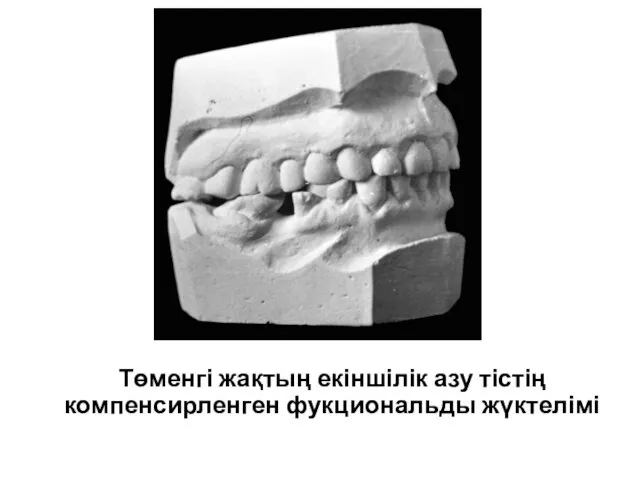 Төменгі жақтың екіншілік азу тістің компенсирленген фукциональды жүктелімі