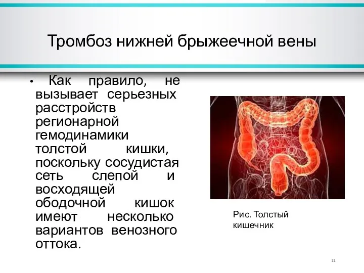 Тромбоз нижней брыжеечной вены Как правило, не вызывает серьезных расстройств