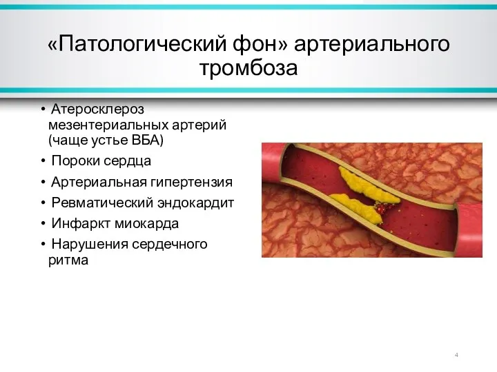 «Патологический фон» артериального тромбоза Атеросклероз мезентериальных артерий (чаще устье ВБА)