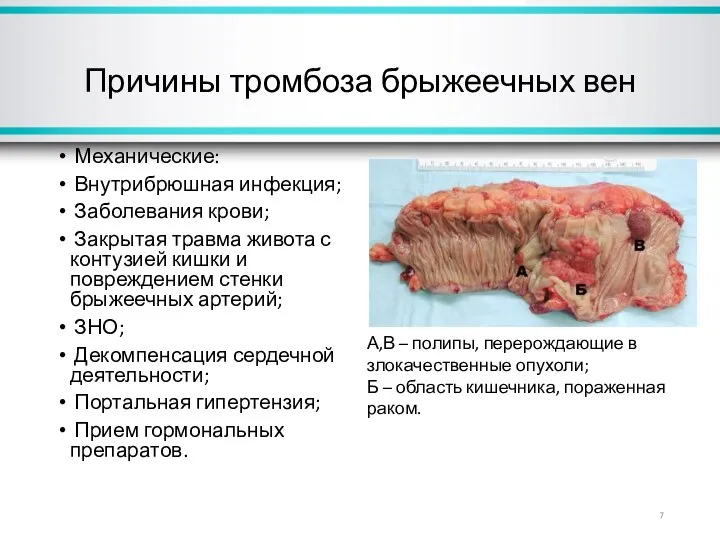 Причины тромбоза брыжеечных вен Механические: Внутрибрюшная инфекция; Заболевания крови; Закрытая