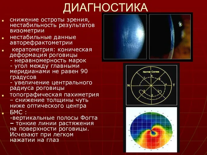 ДИАГНОСТИКА снижение остроты зрения, нестабильность результатов визометрии нестабильные данные авторефрактометрии кератометрия: коническая деформация