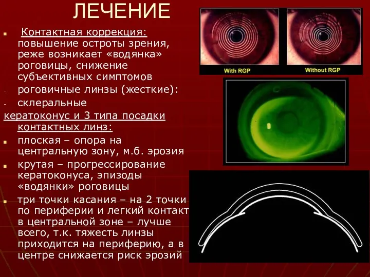 ЛЕЧЕНИЕ Контактная коррекция: повышение остроты зрения, реже возникает «водянка» роговицы,