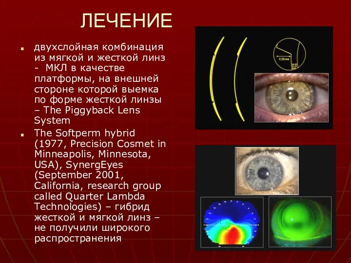 ЛЕЧЕНИЕ двухслойная комбинация из мягкой и жесткой линз - МКЛ