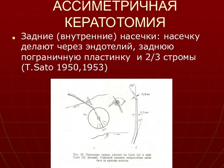 АССИМЕТРИЧНАЯ КЕРАТОТОМИЯ Задние (внутренние) насечки: насечку делают через эндотелий, заднюю пограничную пластинку и