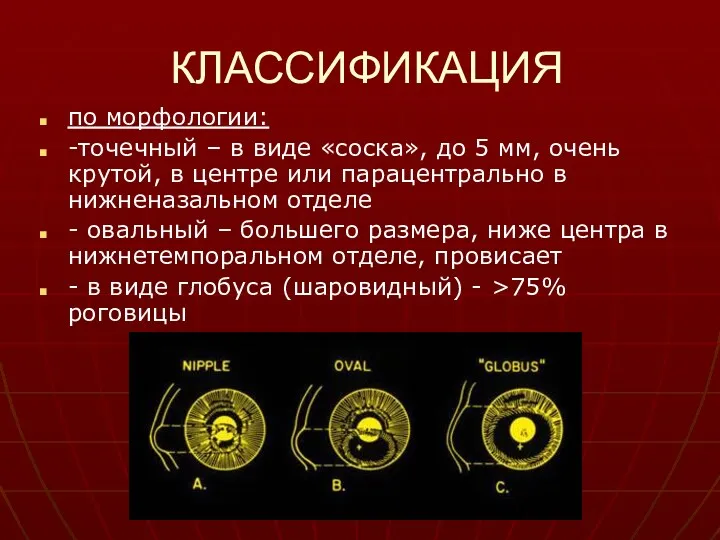 КЛАССИФИКАЦИЯ по морфологии: -точечный – в виде «соска», до 5 мм, очень крутой,