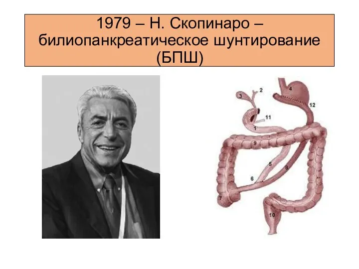 1979 – Н. Скопинаро – билиопанкреатическое шунтирование (БПШ)