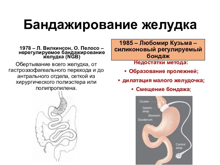 Бандажирование желудка 1978 – Л. Вилкинсон, О. Пелосо – нерегулируемое