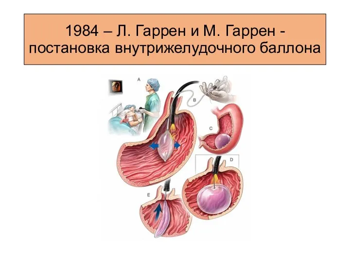 1984 – Л. Гаррен и М. Гаррен - постановка внутрижелудочного баллона