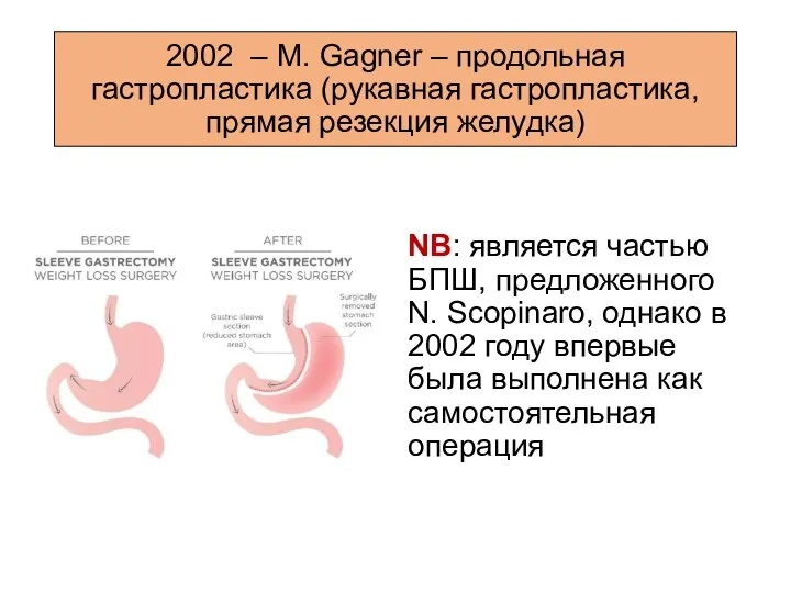 2002 – M. Gagner – продольная гастропластика (рукавная гастропластика, прямая резекция желудка) NB: