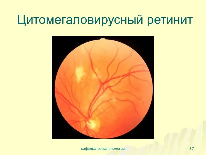 Цитомегаловирусный ретинит кафедра офтальмологии
