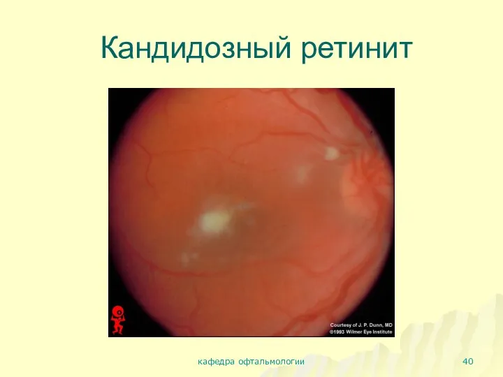 Кандидозный ретинит кафедра офтальмологии