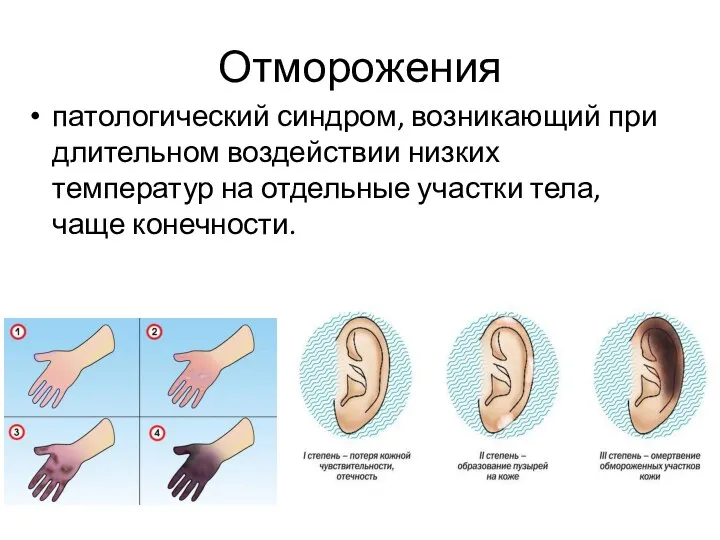 Отморожения патологический синдром, возникающий при длительном воздействии низких температур на отдельные участки тела, чаще конечности.